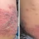 Bé trai 4 tuổi mắc cùng lúc Zona và Thủy đậu, trường hợp hiếm gặp trong y văn