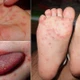 Hà Nội ghi nhận ca mắc bệnh tay chân miệng tăng, 187 ca tại 76 phường xã