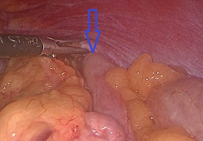 Đại tràng chui qua lỗ thoát vị lên trên ngực trái
