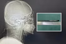 Người đàn ông Trung Quốc sống 8 năm với chiếc đũa mắc kẹt trong cổ họng 