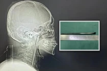Người đàn ông Trung Quốc sống 8 năm với chiếc đũa mắc kẹt trong cổ họng 