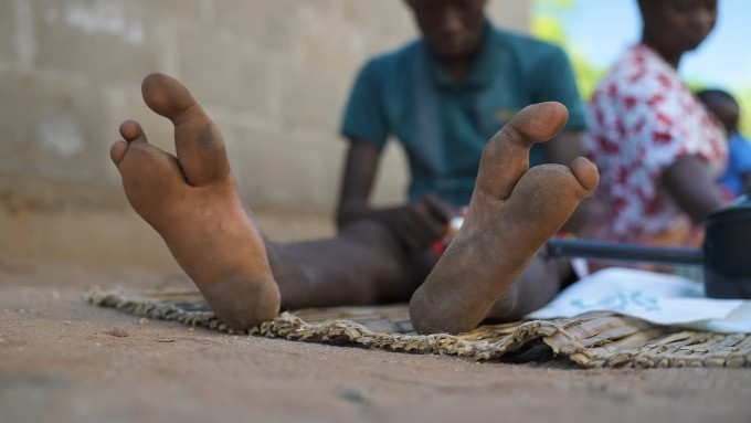 Bi an bo toc “nguoi da dieu