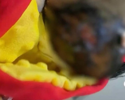 Bé sơ sinh bị bỏng nặng sau đầu do nữ y tá tắm sai quy trình.