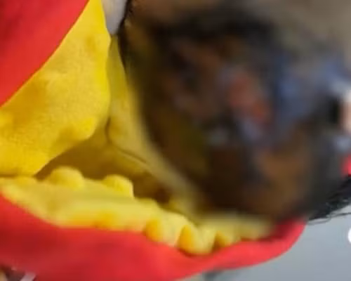 Bé sơ sinh bị bỏng nặng sau đầu do nữ y tá tắm sai quy trình.