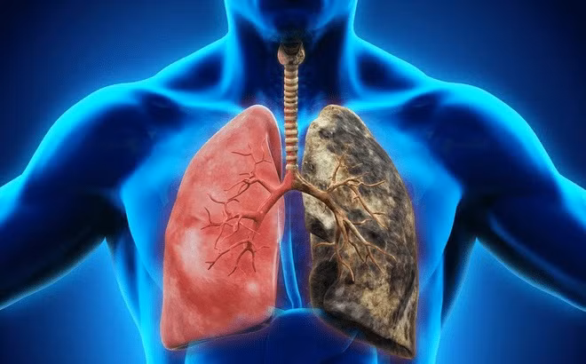 Nhieu can benh ve ung thu co nguyen nhan tu hut thuoc la