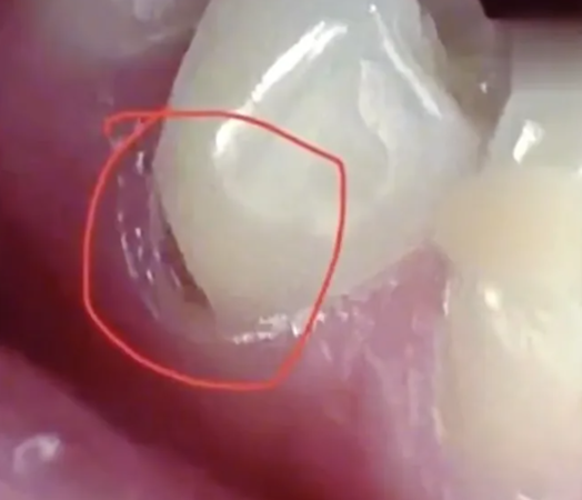 Đánh răng sai cách, cô gái bị hỏng, vỡ chân răng.