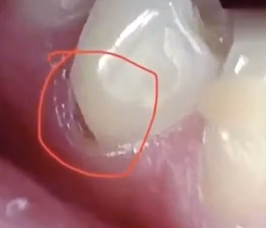 Đánh răng sai cách, cô gái bị hỏng, vỡ chân răng.