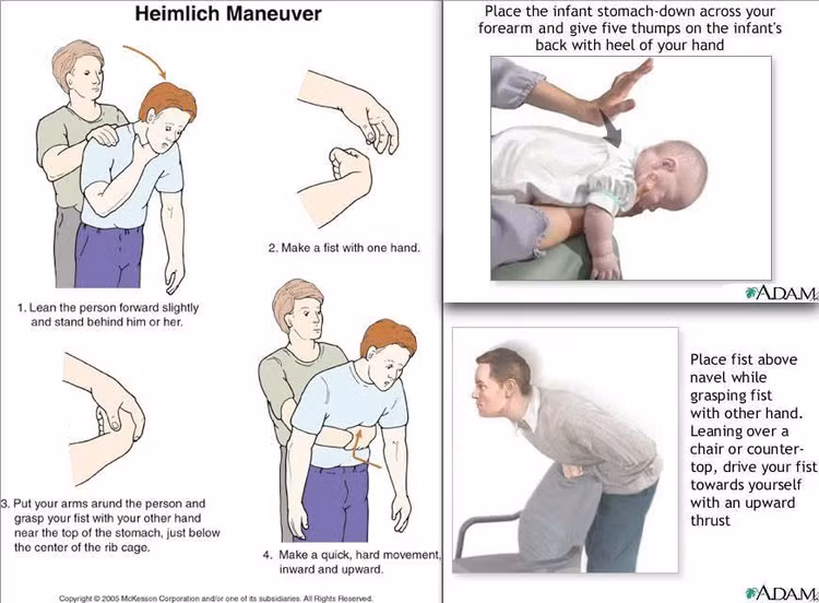 Biện pháp cấp cứu Heimlich - Ảnh BVCC