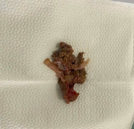 Dị vật được lấy ra - Ảnh BVCC