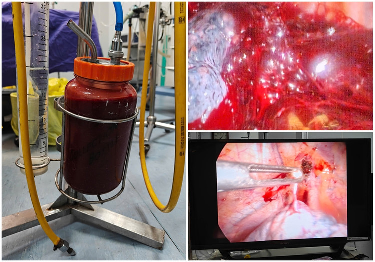 Dẫn lưu màng phổi trái ra 2000 ml, kíp mổ nội soi xử trí cầm máu và khâu kén khí vỡ - Ảnh BVCC