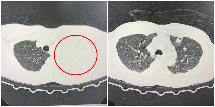 Hình ảnh CLVT phổi trái mờ toàn bộ do chảy máu đã hồi phục tốt sau phẫu thuật.