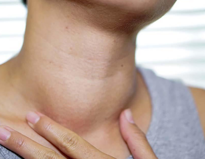 Suy tim, nhiễm khuẩn huyết vì bệnh Basedow - Ảnh minh hoạ