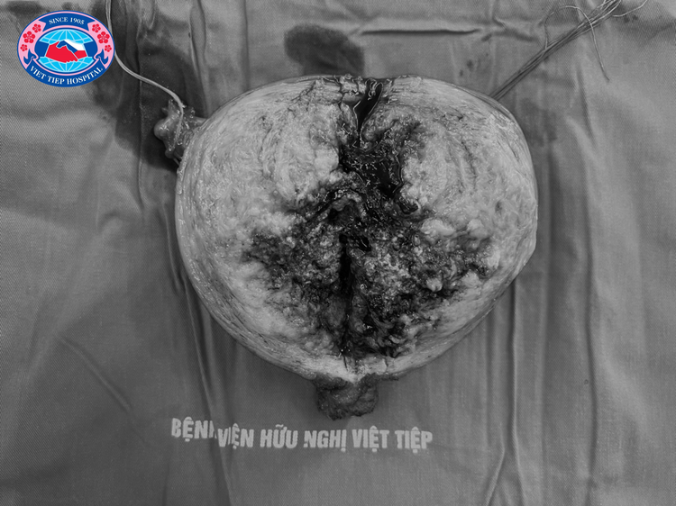 Hình ảnh: Khối u có kích thước 20cm được lấy ra từ cơ thể người bệnh được phẫu tích