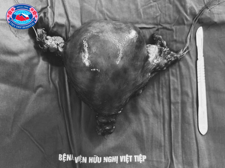 Khối u có kích thước 20cm được lấy ra từ cơ thể người bệnh