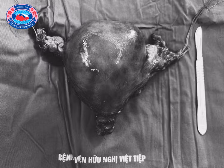 Khối u có kích thước 20cm được lấy ra từ cơ thể người bệnh
