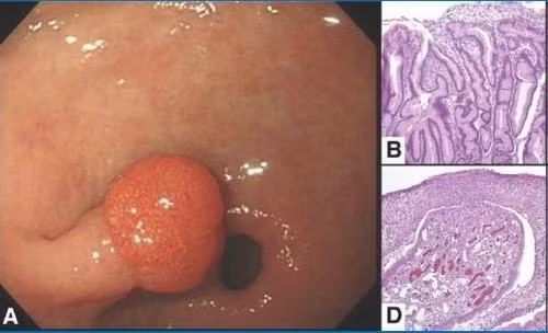 Polyp dạ dày Polyp dạ dày