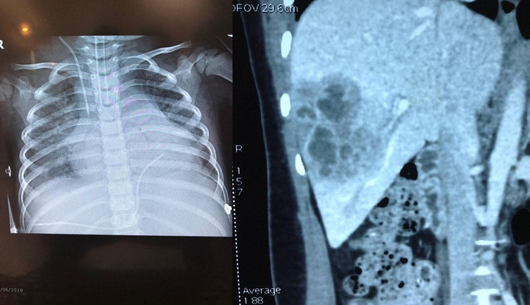Ảnh xquang em bé 3 tuổi bị tràn dịch đa màng: Màng bụng, màng tim, màng phổi do sán lá gan lớn