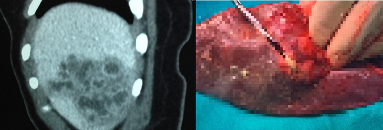 Tổn thương tại gan do sán lá gan ở bệnh nhi 3 tuổi