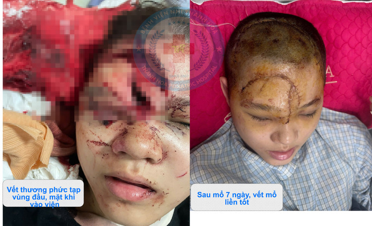 Trẻ chấn thương nghiêm trọng khi ngồi sau xe đạp điện - Ảnh BVCC