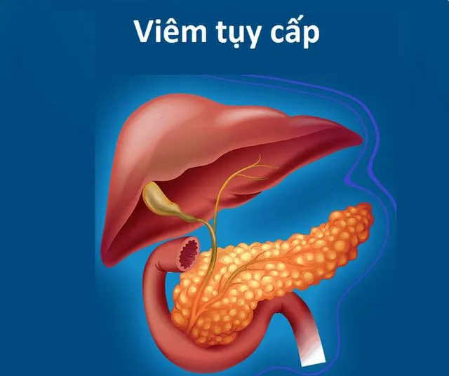 Viêm tụy cấp - Ảnh minh hoạ