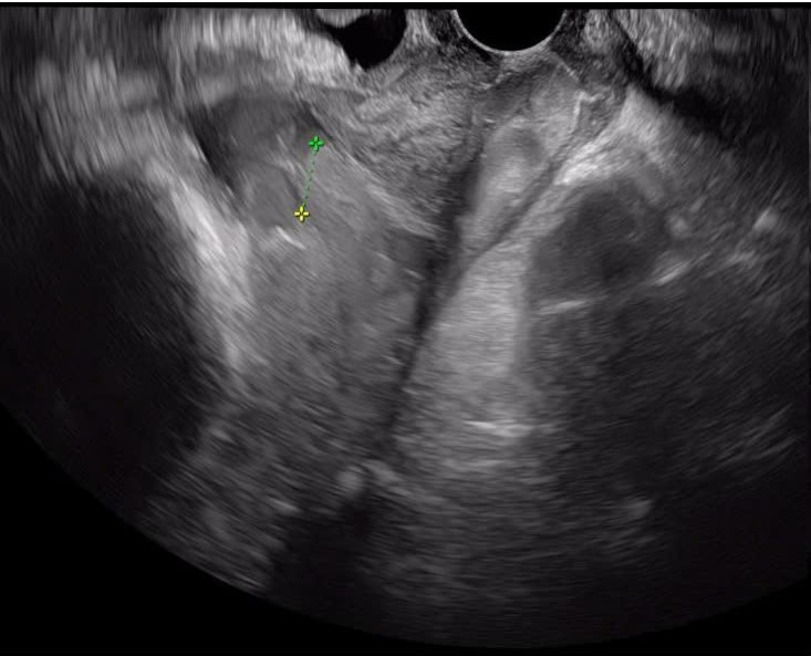 Cuộc chạy đua cấp cứu giành lại sự sống cho sản phụ mạch máu tiền đạo ảnh 2