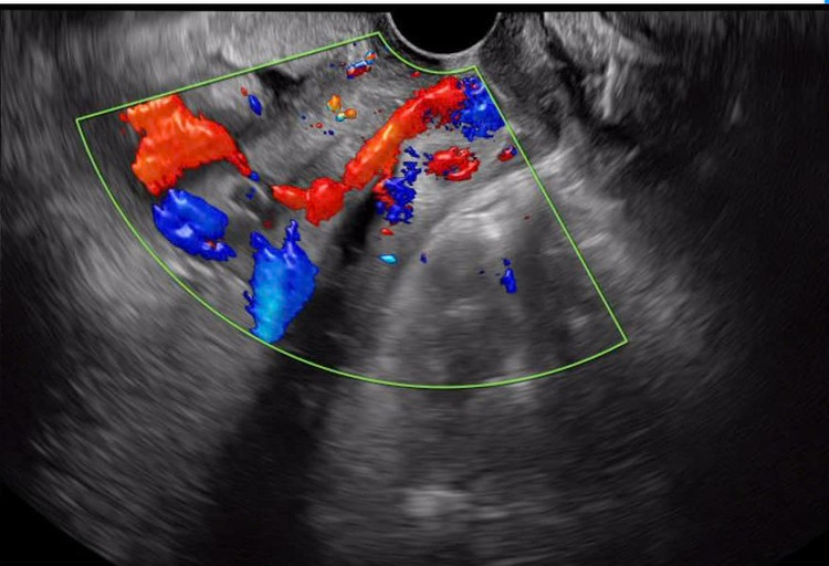 Cuộc chạy đua cấp cứu giành lại sự sống cho sản phụ mạch máu tiền đạo ảnh 1