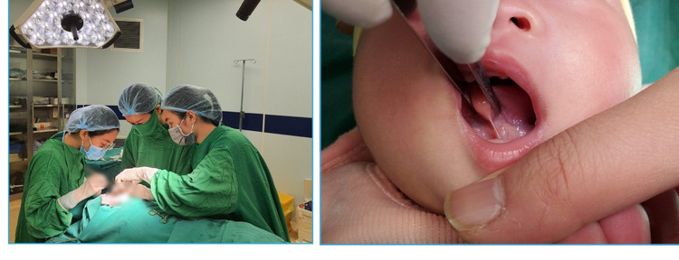 Dính thắng lưỡi ở trẻ mổ càng sớm càng tốt