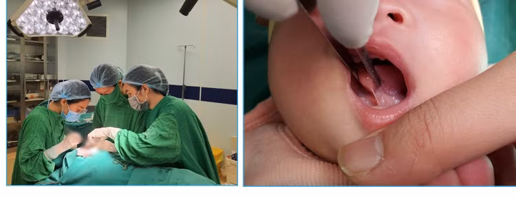 Dính thắng lưỡi ở trẻ mổ càng sớm càng tốt