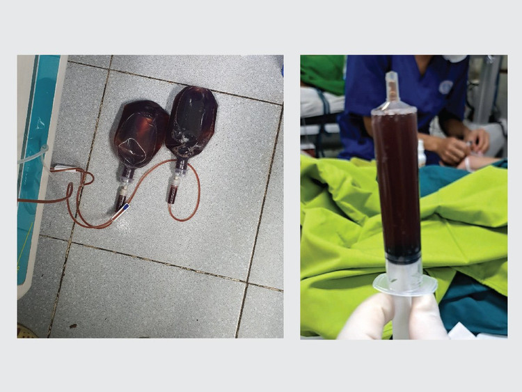 Dịch ổ bụng ở người bệnh viêm tụy hoại tử - Ảnh BVCC