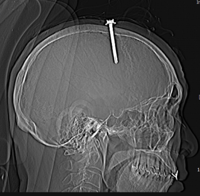 Hình ảnh cây đinh trên phim chụp cắt lớp sọ não - Ảnh BVCC