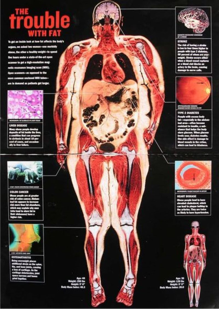 Thừa cân, béo phì gây bệnh xương khớp nào?