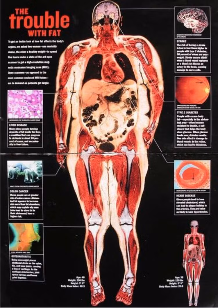 Thừa cân, béo phì gây bệnh xương khớp nào?
