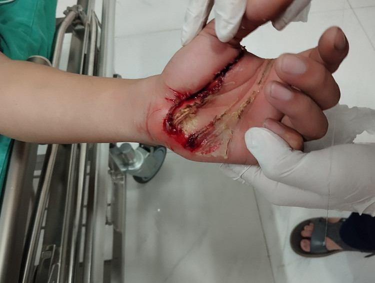 Dùng gậy nhôm gạt dây điện, nam thanh niên bị điện giật bỏng nặng ảnh 2