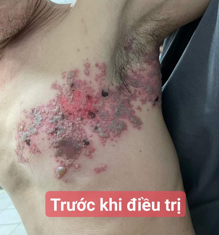 Biểu hiện của zona thần kinh