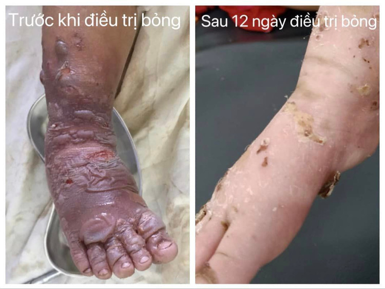 Trẻ bị bỏng nước sôi được điều trị tại Khoa Ngoại