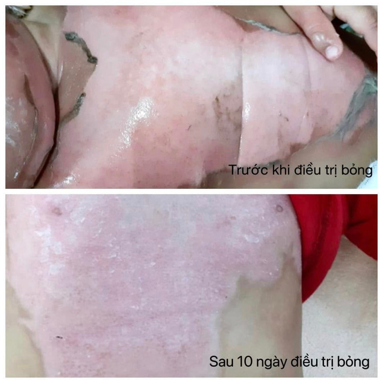 Trẻ bị bỏng nước bình năng lượng mặt trời được điều trị tại Khoa Ngoại - Bệnh viện Sản Nhi Bắc Giang