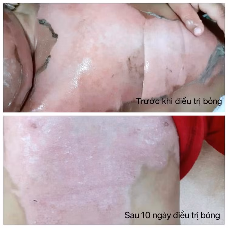 Trẻ bị bỏng nước bình năng lượng mặt trời được điều trị tại Khoa Ngoại - Bệnh viện Sản Nhi Bắc Giang