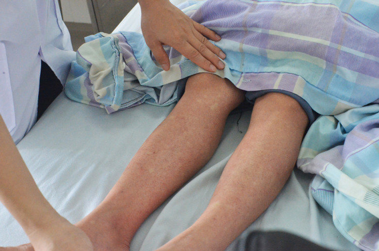 Bệnh nhân bị sốt xuất huyết có chấm mảng xuất huyết dưới da