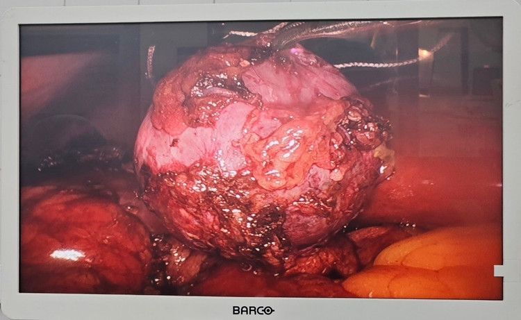 Khối u được bóc tách lấy ra khỏi cơ thể