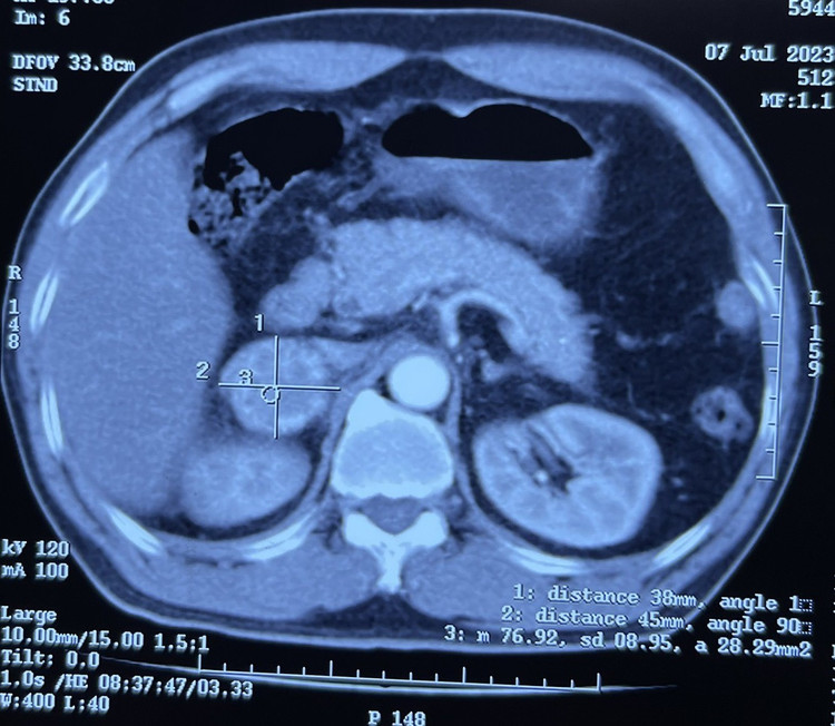 Khối u trên phim chụp cắt lớp vi tính)