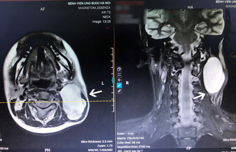 Phim chụp u khổng lồ ở vị trí nguy hiểm ở cổ thiếu nữ