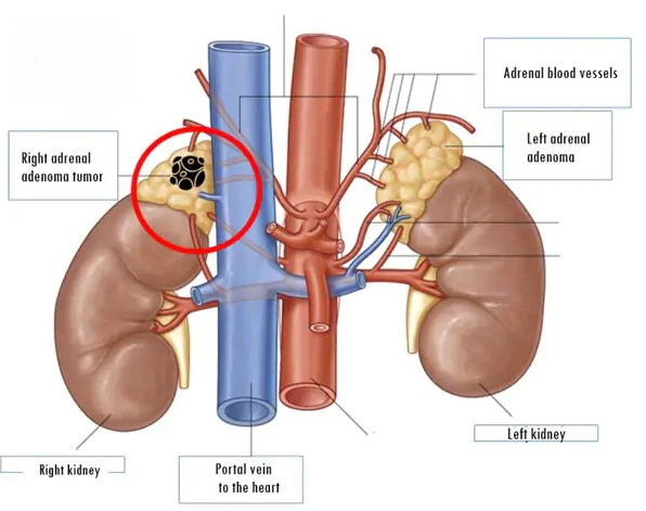 Vị trí khối u trên hình ảnh mô phỏng giải phẫu)