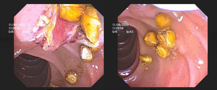 Sỏi trong ống mật chủ