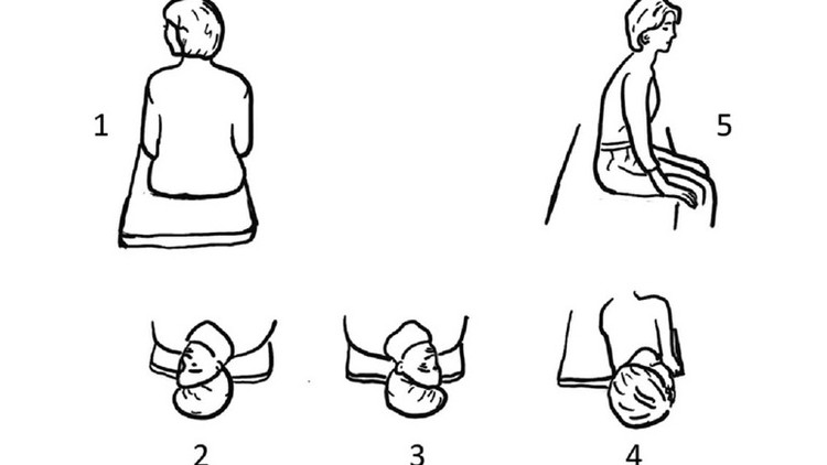 Phương pháp điều trị nghiệm pháp Epley