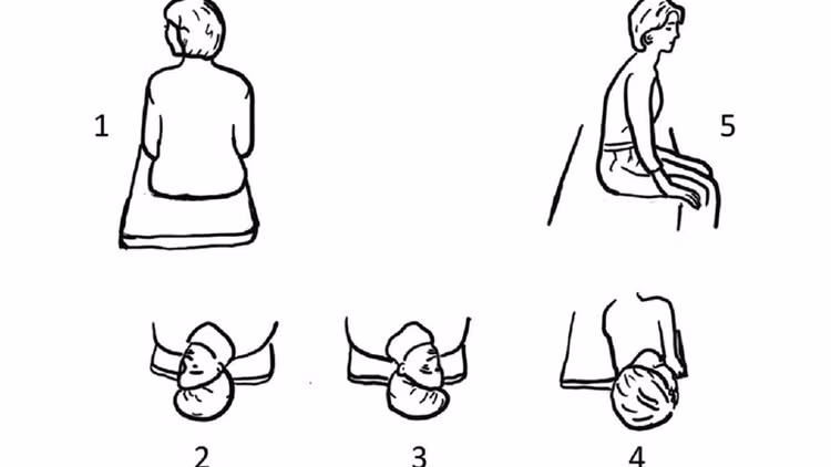 Phương pháp điều trị nghiệm pháp Epley