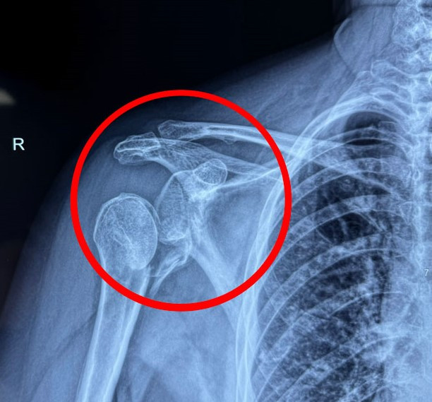 Phim chụp X-quang cho thấy khớp vai người bệnh gãy rời hoàn toàn.