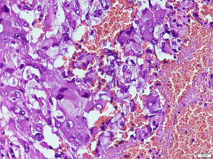 Hình ảnh U tế bào ưa chrom hỗn hợp dưới kính hiển vi - Ảnh BVCC