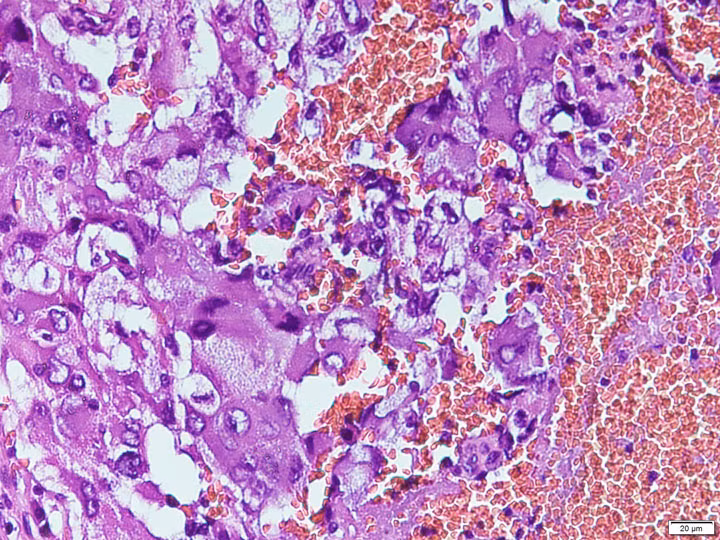 Hình ảnh U tế bào ưa chrom hỗn hợp dưới kính hiển vi - Ảnh BVCC