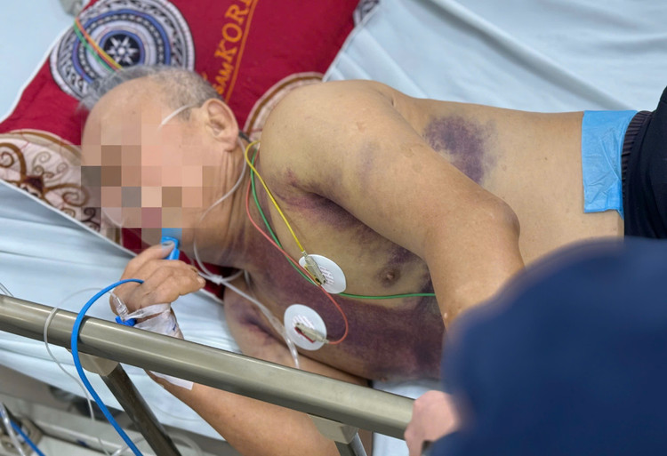Bệnh nhân sốt xuất huyết nguy kịch - Ảnh BVCC