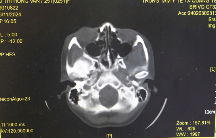 Hình ảnh tổn thương trên phim chụp - ảnh BVCC